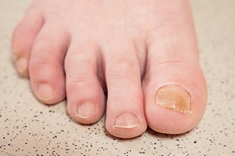 fungal nail