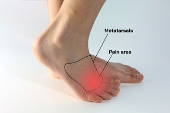 mortons neuroma